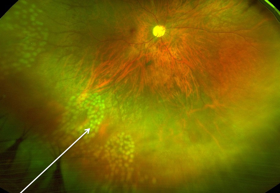 lasered-retinal-tear
