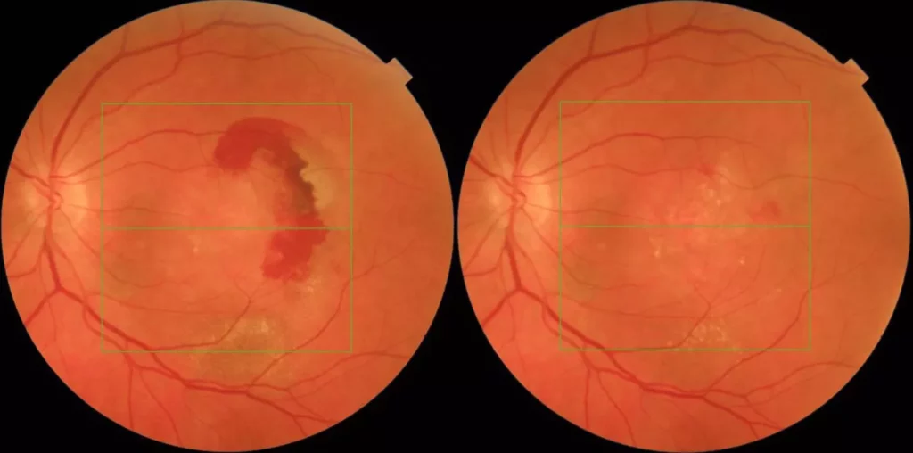 AMD The Retina Clinic, London.