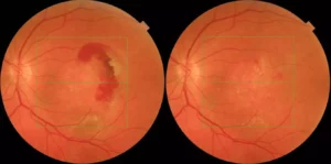 AMD The Retina Clinic, London.