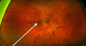 The Retina Clinic, London, Macular