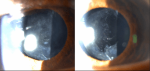 The Retina Clinic London YAG Posterior Capsulotomy Laser